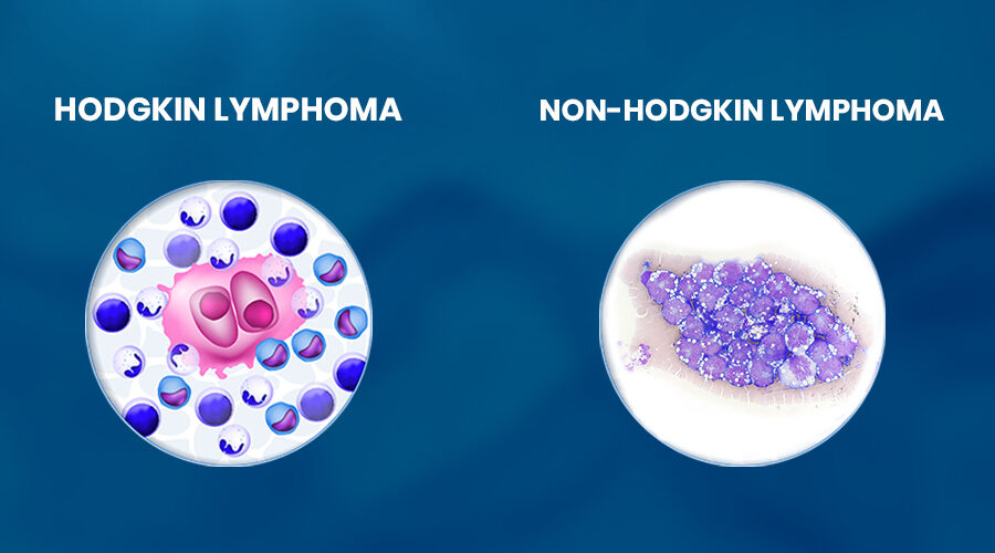 Hodgkin VS Non-Hodgkin Lymphoma