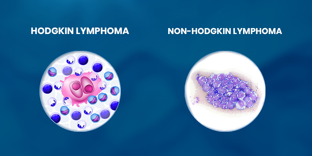 Hodgkin VS Non-Hodgkin Lymphoma