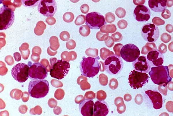 Chronic Myeloproliferative Disorder