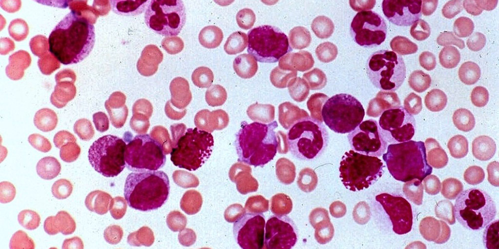 Chronic Myeloproliferative Disorder