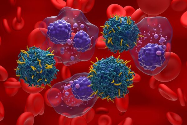 Monoclonal Gammopathy of Undetermined Significance (MGUS)