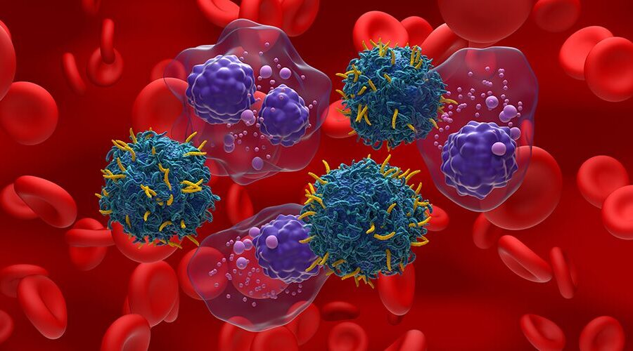 Monoclonal Gammopathy of Undetermined Significance (MGUS)