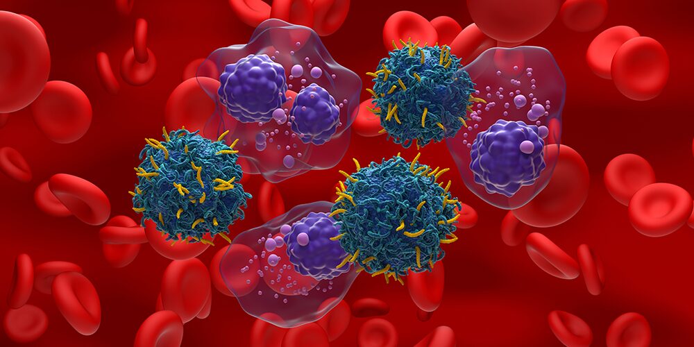 Monoclonal Gammopathy of Undetermined Significance (MGUS)