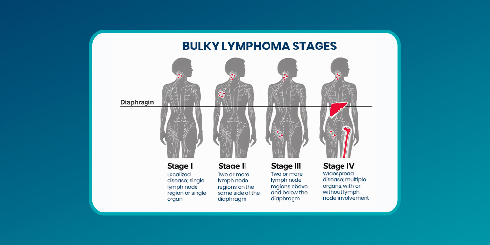 7 Levels of Lymph Nodes in Neck - Cervical Lymph Nodes