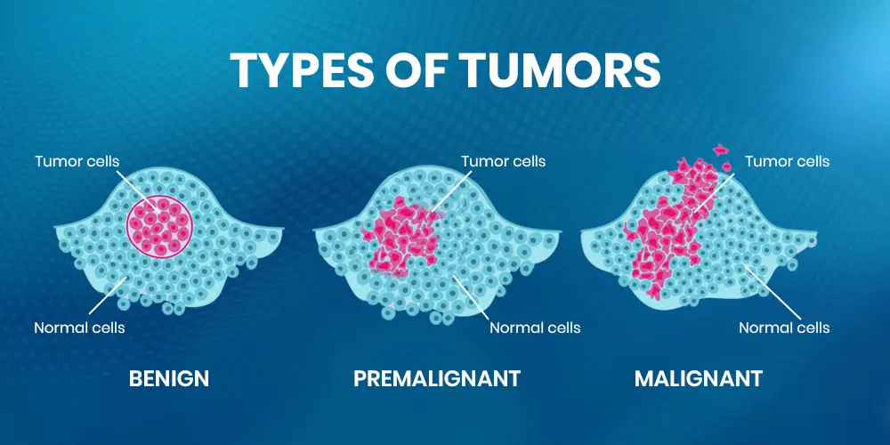 How Many Types Of Benign Tumors Are There