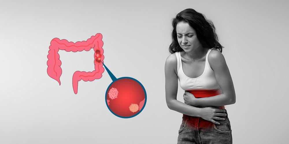 How Serious is a Tubular Adenoma