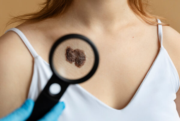 Cutaneous T-Cell Lymphoma