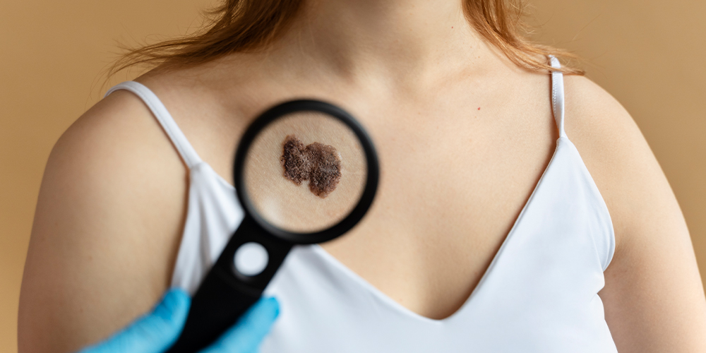 Cutaneous T-Cell Lymphoma