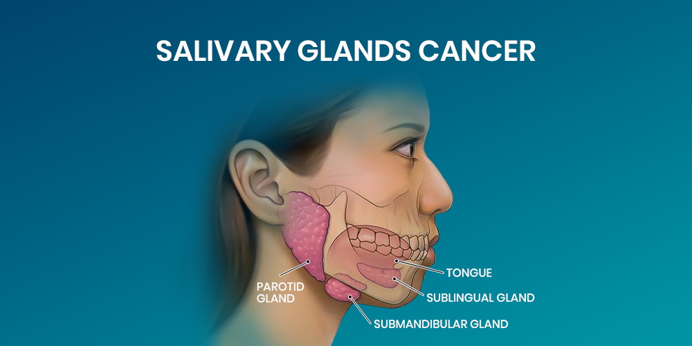 Majors Salivary Gland Cancer