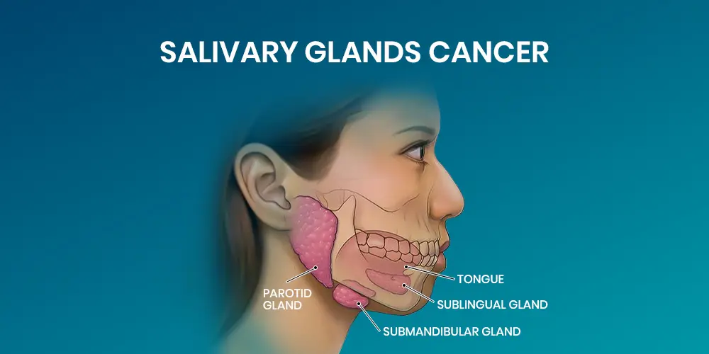 Salivary Gland Cancer: Symptoms, Causes and Treatment Options