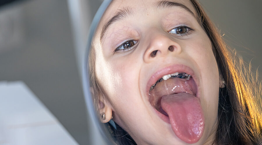 Palate Cancer (Roof of the Mouth)