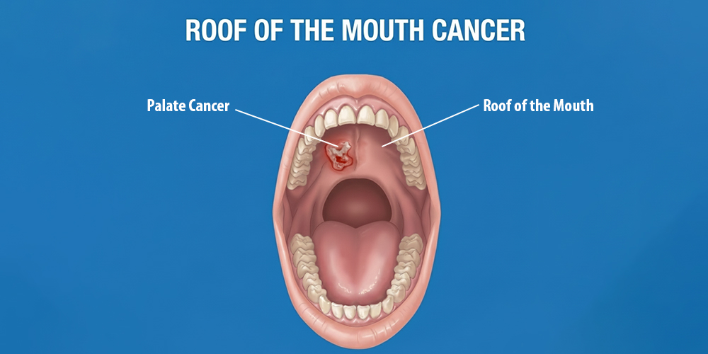 Roof of the Mouth Cancer