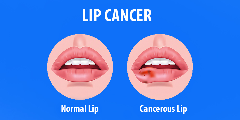 Normal Lip VS Cancerous Lip