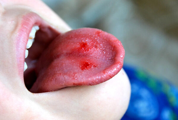 tongue cancer