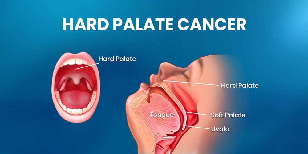 hard palate