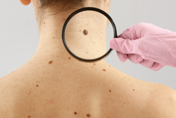 Melanoma