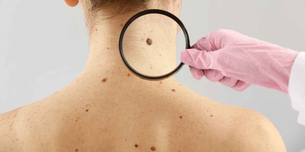 Melanoma