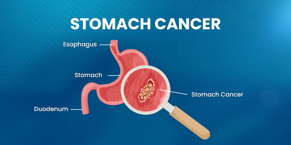 Stomach Cancer guide