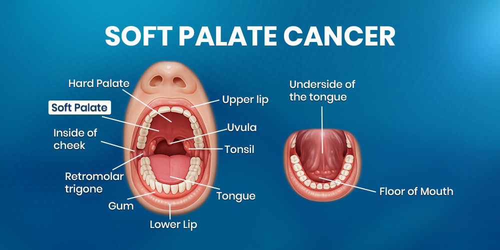 What is Soft Palate Cancer