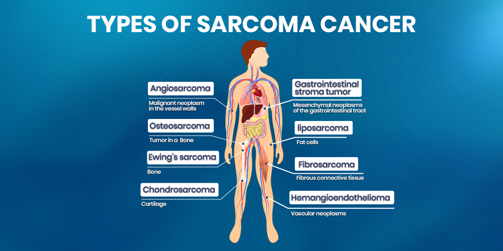 types of sarcoma cancer