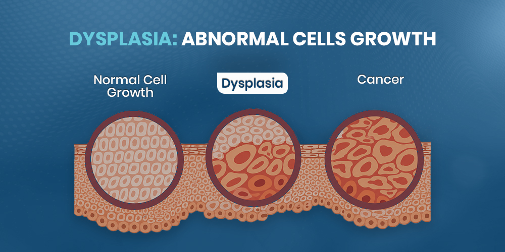 Dysplasia Abnormal Cells Growth