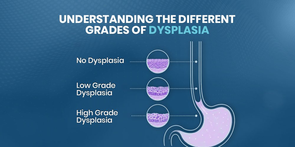 Understanding the Different Grades of Dysplasia