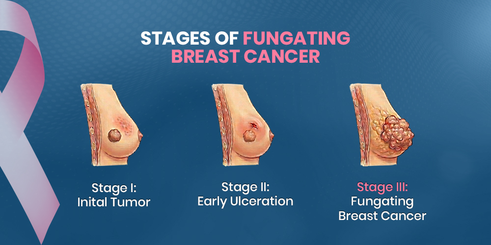 stages of fungating breast cancer