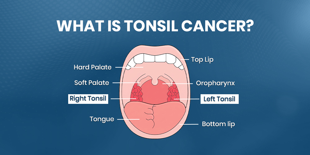 what is tonsil cancer