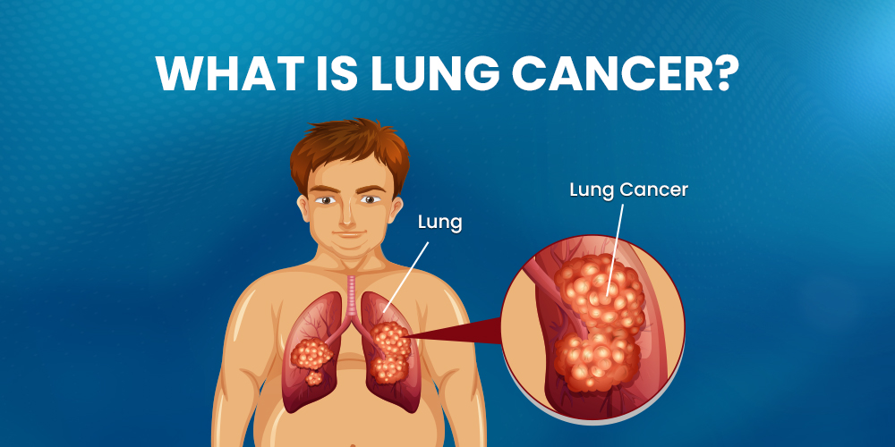 What is Lung Cancer