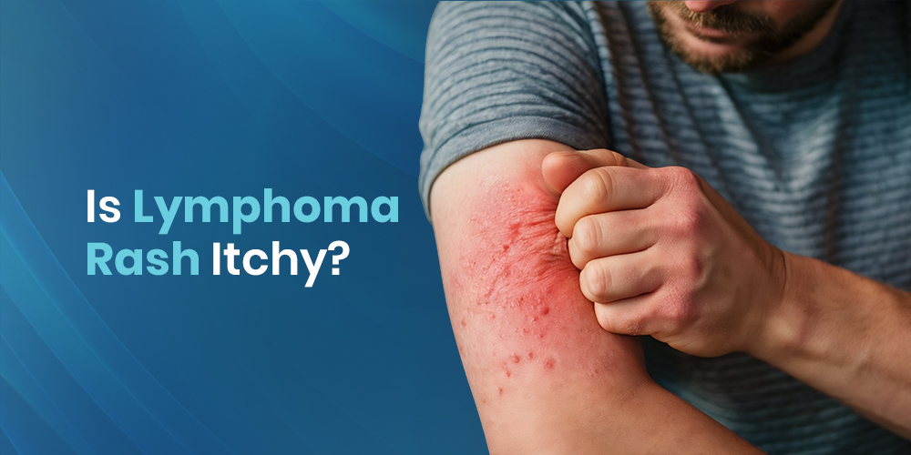 Is Lymphoma Rash Itchy