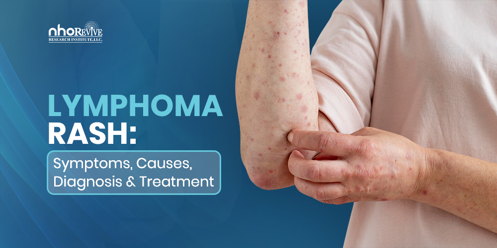 Lymphoma Rash