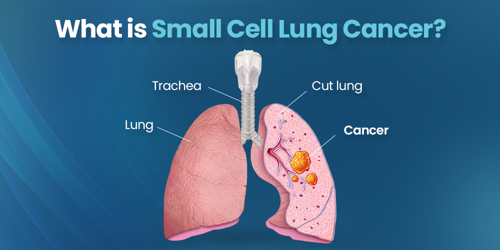 What is Small Cell Lung Cancer
