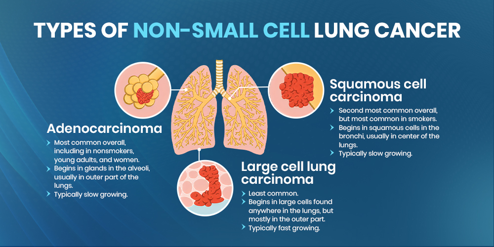 types of non small cell lung cancer