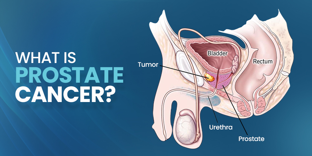 What Is Prostate Cancer