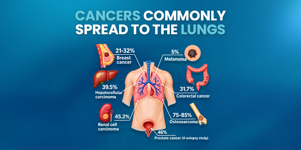 Cancers commonly spread to the Lungs