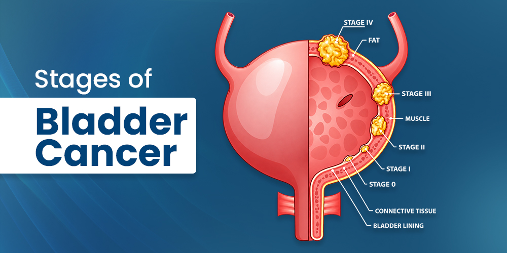 Stages of Bladder Cancer